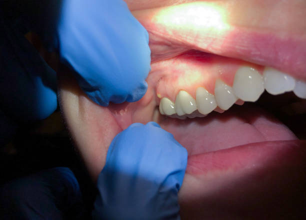 Best Emergency Denture Repair in Hargill, TX